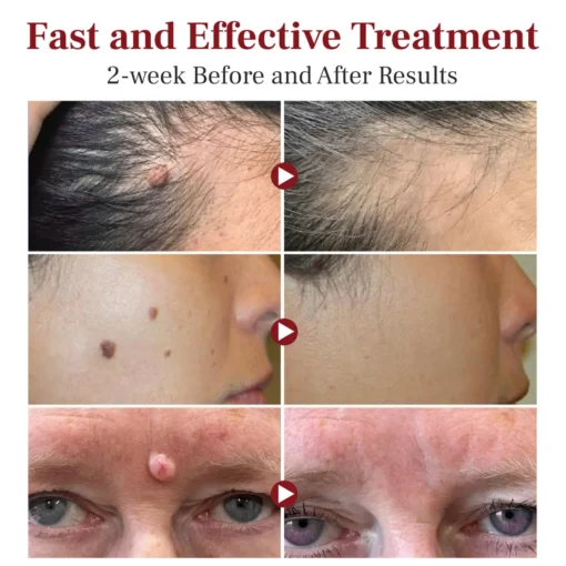 DAFEILA® LumeSkin Mole and Wart Removal Laser Pen