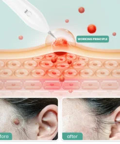 Dafeila® Advanced Plasma Laser Spot Cleaning Pen