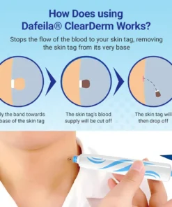 Dafeila® ClearDerm At-home Skin Tag Removal Pen