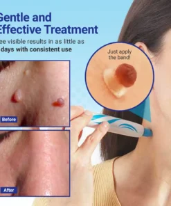 Dafeila® ClearDerm At-home Skin Tag Removal Pen