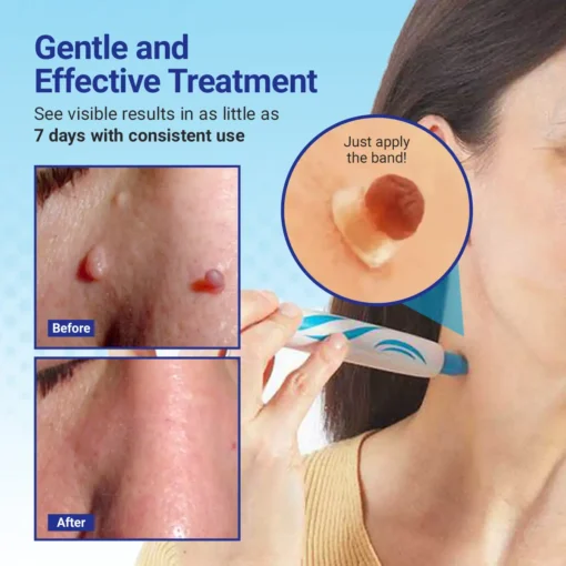 Dafeila® ClearDerm At-home Skin Tag Removal Pen