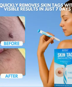 Dafeila® Skin Tag Removal Pen