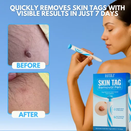Dafeila® Skin Tag Removal Pen