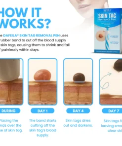 Dafeila® Skin Tag Removal Pen
