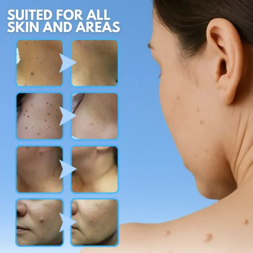 Dafeila® Skin Tag Removal Pen