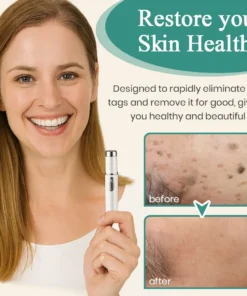 DAFEILA® LumeSkin Mole and Wart Instant Removal Laser Pen 4