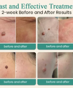 DAFEILA® LumeSkin Mole and Wart Instant Removal Laser Pen ACE 3