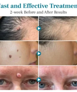 DAFEILA® LumeSkin Mole and Wart Removal Laser Pen Ultra01