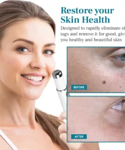 DAFEILA® LumeSkin Mole and Wart Removal Laser Pen Ultra01