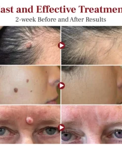 DAFEILA® LumeSkin Mole and Wart Removal Laser PenUltra02